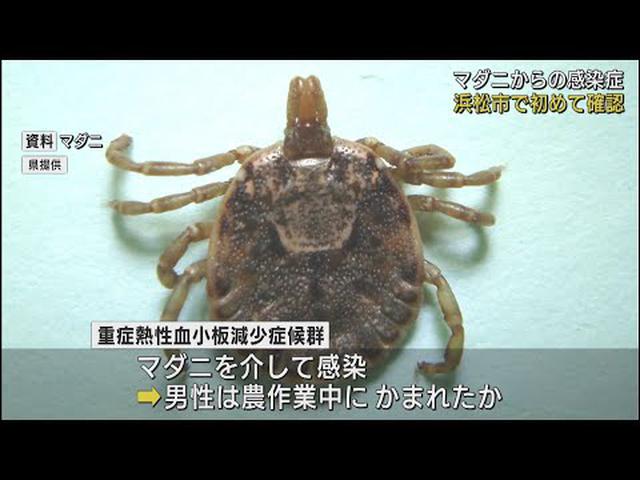 画像: マダニから感染…　浜松市で重症熱性血小板減少症候群の患者を確認 youtu.be