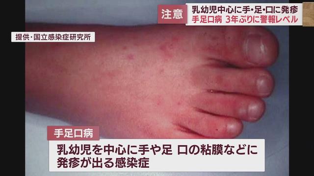 画像: 3年ぶり「手足口病」の感染者数が警報レベルに　静岡県が注意呼びかけ youtu.be